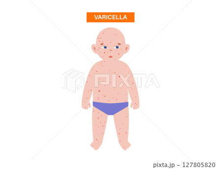 Varicella or chickenpox 127805820
