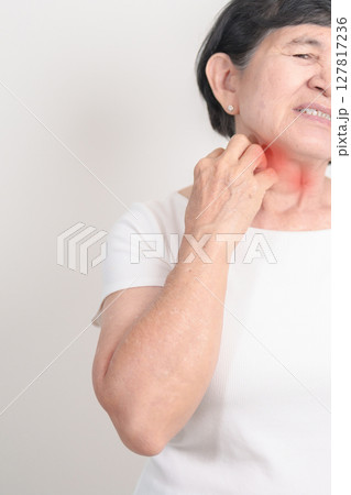 Elderly woman itching Neck and body scratching for Skin Allergy from insect bite and food dermatitis. Dermatology, Leprosy day, Systemic lupus erythematosus, Psoriasis, Urticaria and rash Eczema 127817236