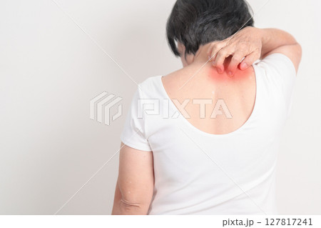 Elderly woman itching Neck and body scratching for Skin Allergy from insect bite and food dermatitis. Dermatology, Leprosy day, Systemic lupus erythematosus, Psoriasis, Urticaria and rash Eczema Elderly woman itching Neck and body scratching for Skin Allergy from insect bite and food dermatitis. Dermatology, Leprosy day, Systemic lupus erythematosus, Psoriasis, Urticaria and rash Eczema 127817241