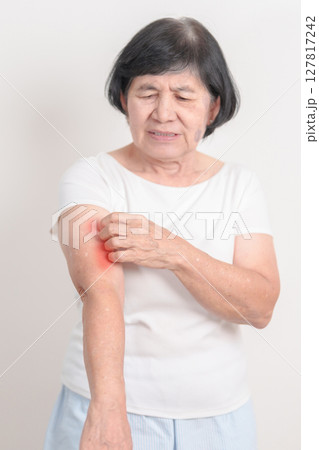 Elderly woman itching arm and body scratching for Skin Allergy from insect bite and food dermatitis. Dermatology, Leprosy day, Systemic lupus erythematosus, Psoriasis, Urticaria and rash Eczema 127817242