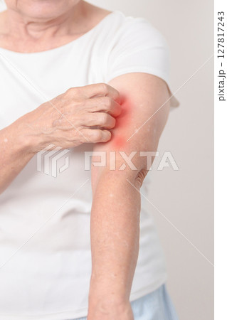 Elderly woman itching arm and body scratching for Skin Allergy from insect bite and food dermatitis. Dermatology, Leprosy day, Systemic lupus erythematosus, Psoriasis, Urticaria and rash Eczema 127817243