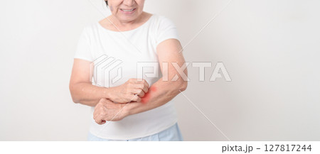 Elderly woman itching arm and body scratching for Skin Allergy from insect bite and food dermatitis. Dermatology, Leprosy day, Systemic lupus erythematosus, Psoriasis, Urticaria and rash Eczema 127817244