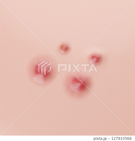 炎症を起こした赤ニキビのケアと治療をテーマにしたスキンケアの3Dイラスト 炎症を起こした赤ニキビのケアと治療をテーマにしたスキンケアの3Dイラスト 127833568