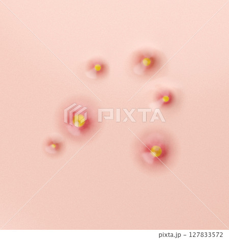 重度の赤ニキビや炎症の治療イメージ 美容皮膚科向け3Dイラスト 127833572