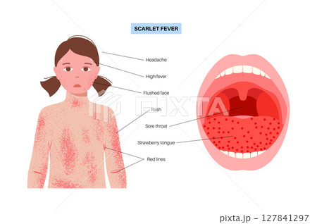 Scarlet fever poster Scarlet fever poster 127841297