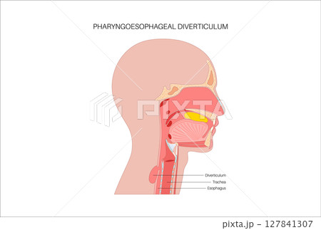 Pharyngoesophageal diverticulum poster Pharyngoesophageal diverticulum poster 127841307