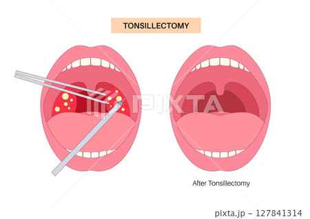 Tonsillectomy procedure poster Tonsillectomy procedure poster 127841314