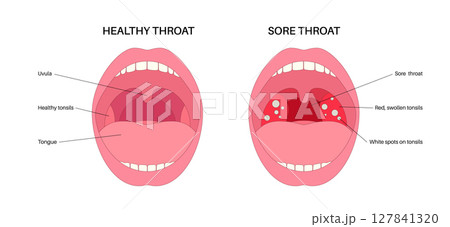 Sore throat poster Sore throat poster 127841320