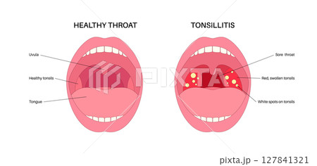 Tonsillitis Oral Desease Tonsillitis Oral Desease 127841321