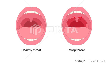 Strep throat poster 127841324
