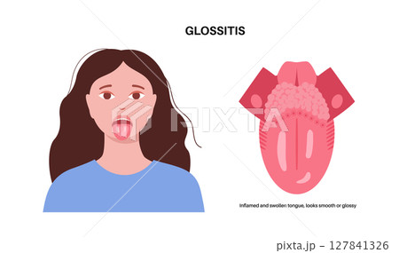 Glossitis medical poster 127841326