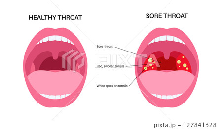 Sore throat poster 127841328