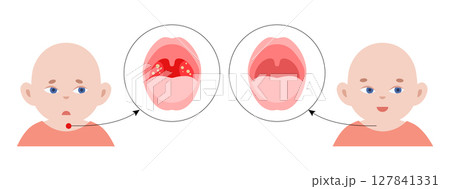 Tonsillitis Oral Desease 127841331