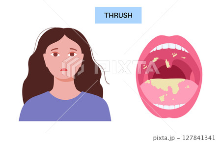 Thrush disease poster Thrush disease poster 127841341