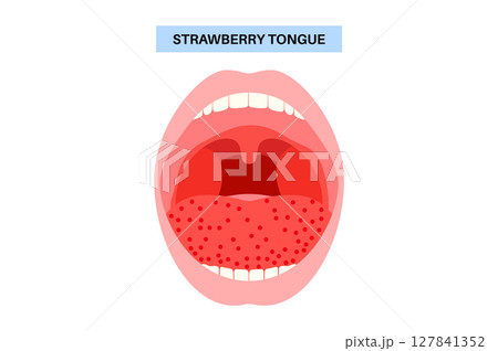 Strawberry tongue poster 127841352