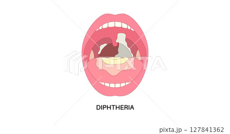 diphtheria oral disease 127841362
