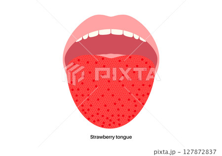 Strawberry tongue poster 127872837
