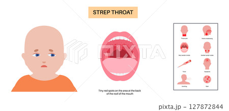 Strep throat poster Strep throat poster 127872844