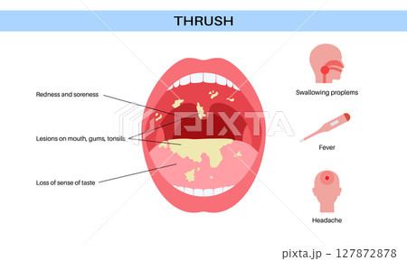 Thrush disease poster 127872878