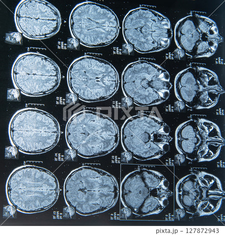 MRI scan image of brain for diagnosis 127872943
