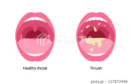 Thrush disease poster 127872946