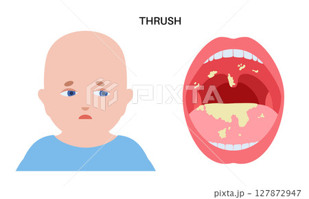 Thrush disease poster 127872947