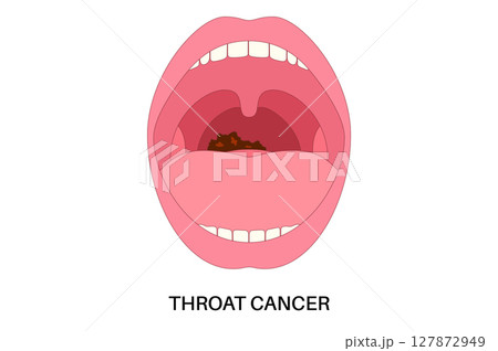 Throat cancer poster 127872949
