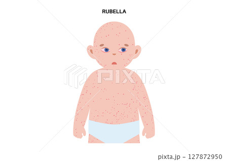 Measles or rubeola symptoms 127872950