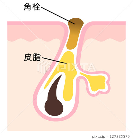 毛穴の断面　角栓と皮脂　詰まった毛穴 127885579
