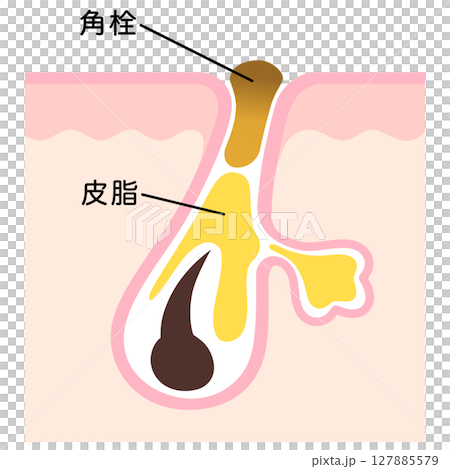 毛穴の断面　角栓と皮脂　詰まった毛穴 127885579