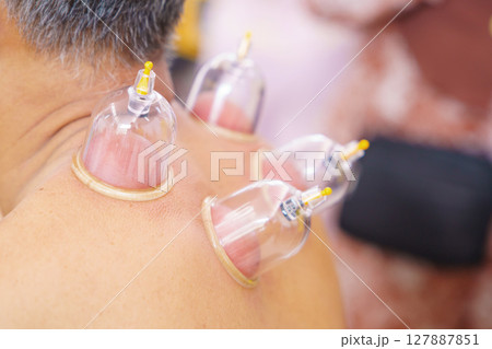 Close up for multiple vacuum cups, medical cupping therapy on human body. Doctor with cups for patient, therapy. Wellness, health injury rehabilitation concept. Alternative medicine Close up for multiple vacuum cups, medical cupping therapy on human body. Doctor with cups for patient, therapy. Wellness, health injury rehabilitation concept. Alternative medicine 127887851