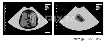 Ultrasound scan showing monozygotic twins during pregnancy Ultrasound scan showing monozygotic twins during pregnancy 127890575