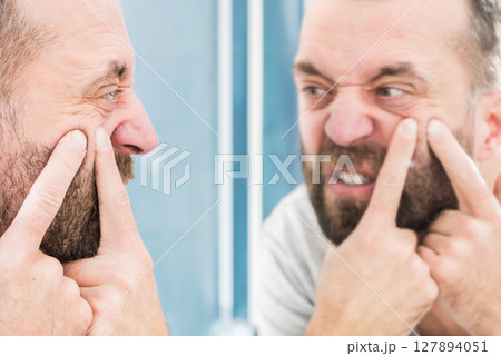 Man looking at pimples on his face 127894051