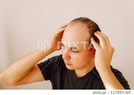 Baldness on the head of a middle-aged man. Hair loss. Male hair loss, early baldness and alopecia. 127895160