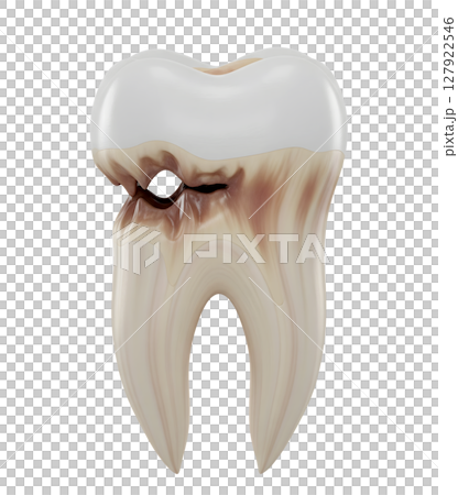 Decayed Molar with a Cavity Minimalist 3D Rendering in a Soft And Smooth Renderer 127922546
