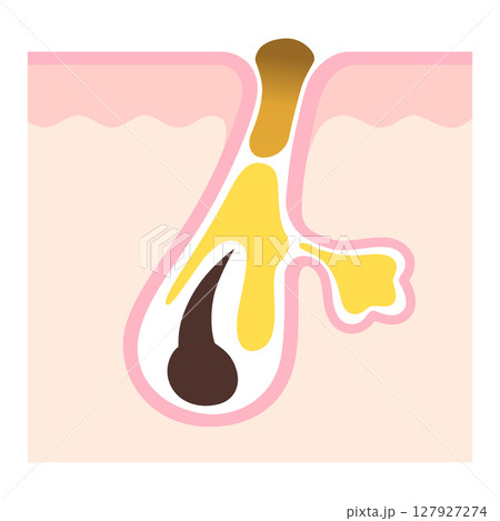 毛穴の断面 角栓と皮脂 詰まった毛穴 毛穴の断面 角栓と皮脂 詰まった毛穴 127927274
