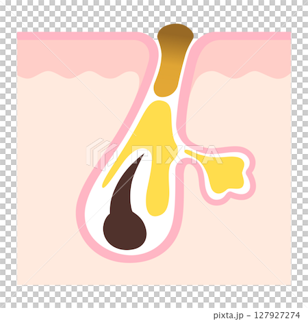 毛穴の断面 角栓と皮脂 詰まった毛穴 毛穴の断面 角栓と皮脂 詰まった毛穴 127927274