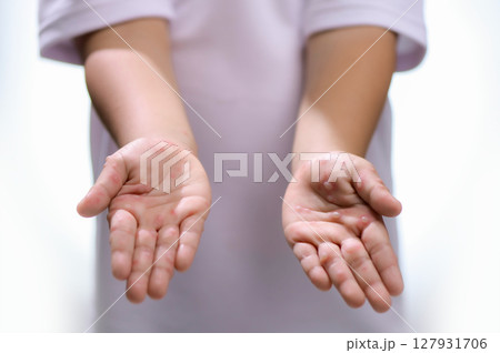Hand, foot and mouth disease HFMD Human hand of scarlet fever in coxsackievirus palmarosa virus and child hand on white background Hand, foot and mouth disease HFMD Human hand of scarlet fever in coxsackievirus palmarosa virus and child hand on white background 127931706