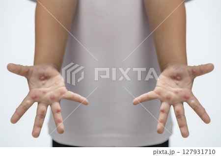 Hand, foot and mouth disease HFMD Human hand of scarlet fever in coxsackievirus palmarosa virus and child hand on white background Hand, foot and mouth disease HFMD Human hand of scarlet fever in coxsackievirus palmarosa virus and child hand on white background 127931710