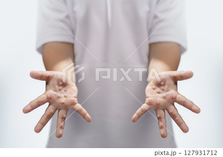 Hand, foot and mouth disease HFMD Human hand of scarlet fever in coxsackievirus palmarosa virus and child hand on white background 127931712