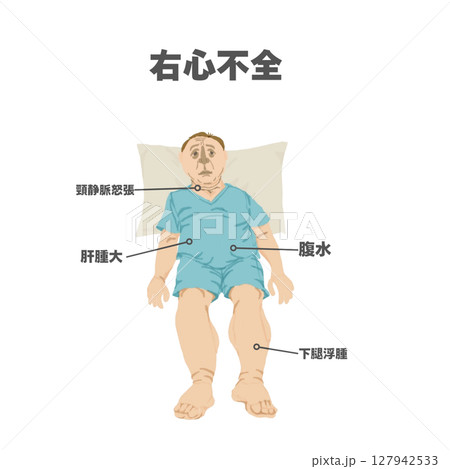 右心不全の身体所見（イラスト図解） 127942533