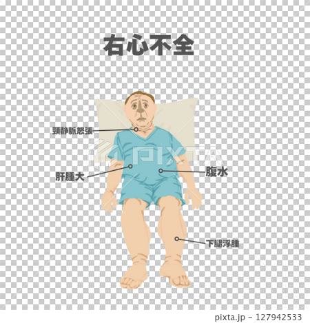 Physical findings of right heart failure (illustration) 127942533