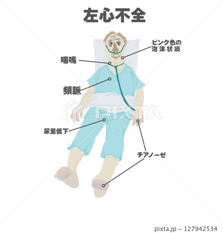 左心不全の身体所見（イラスト図解） 127942534