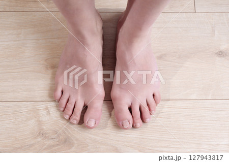Close-up view of a woman's feet with damaged toenails and crooked toes on a wooden floor, emphasizing the importance of proper nail care and effective treatment for healthier feet Close-up view of a woman's feet with damaged toenails and crooked toes on a wooden floor, emphasizing the importance of proper nail care and effective treatment for healthier feet 127943817