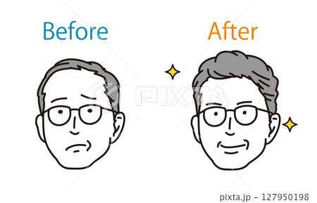 薄毛の男性と毛髪トラブルのビフォーアフターイラスト 127950198