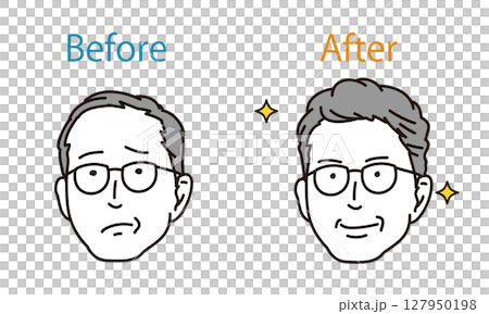 一位患有頭髮稀疏和頭髮問題的男士的治療前後對比圖 一位患有頭髮稀疏和頭髮問題的男士的治療前後對比圖 127950198