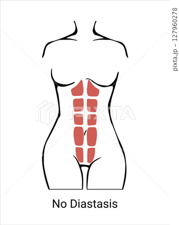 No Diastasis. Diastasis in a woman before, during and after pregnancy. The anatomy of a Woman. A woman's muscular corset before and after childbirth. Vector illustration No Diastasis. Diastasis in a woman before, during and after pregnancy. The anatomy of a Woman. A woman's muscular corset before and after childbirth. Vector illustration 127960278