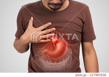Hiatal Hernia causes upper stomach bulge shown in medical illustration. 127965036