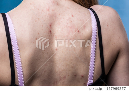 woman with skin problem acne on back 127969277