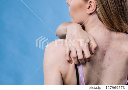 Woman with skin problem acne on back 127969278